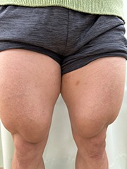 メディセル・手技によるケアの様子